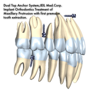 Dual Top Anchor System