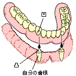 OVERDENTURE