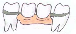 局部義歯図