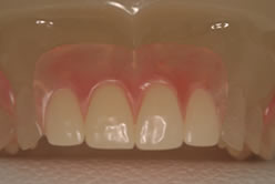 smile denture