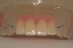 denture